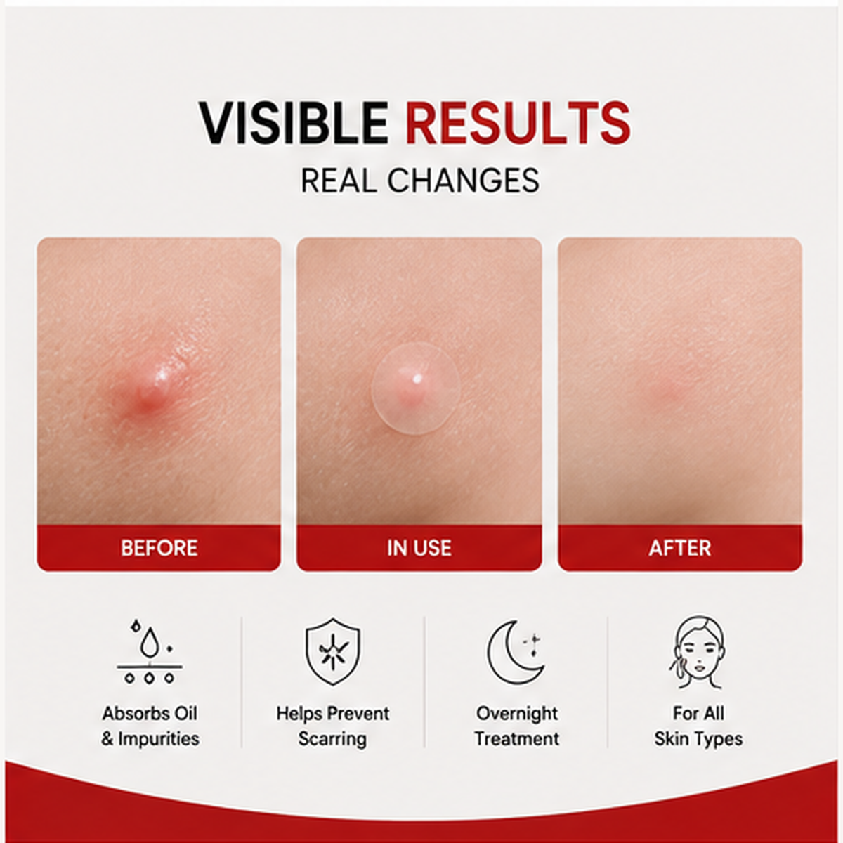 Hydrocolloid Acne Pimple Patches – 144 Patches