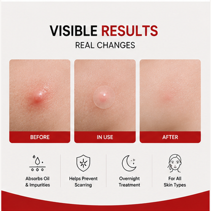 Hydrocolloid Acne Pimple Patches – 144 Patches